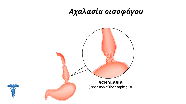 Αχαλασία οισοφάγου