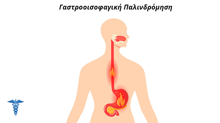 γαστροοισοφαγική παλινδρόμηση